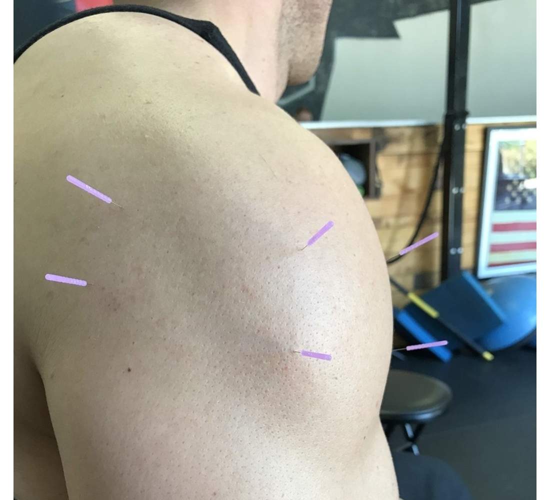 What Is Dry Needling Purpose Benefits And Usage vrogue.co